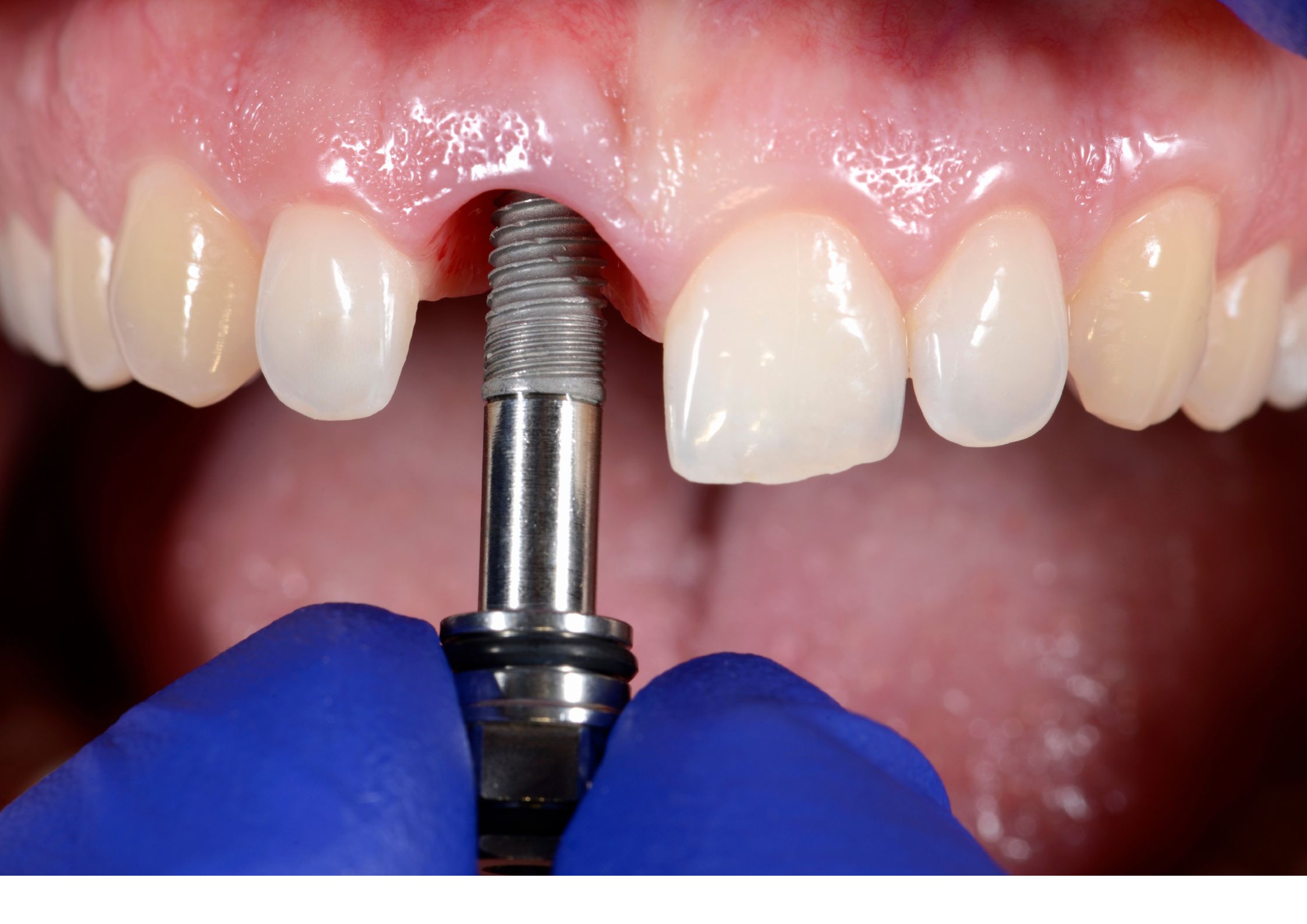 Implantes Dentários
